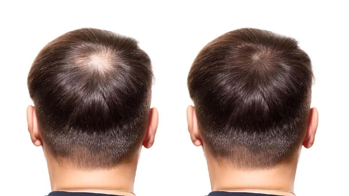 Crown area hair restoration